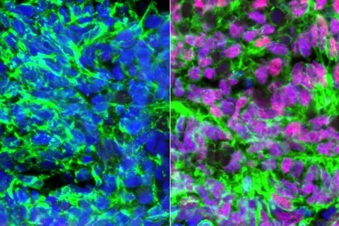 Human embryonic stem cell-derived neurons (green) showing nuclei in blue. Left: with retinoic acid added. Right: with retinoic acid and BMP4 added, creating proprioceptive sensory interneurons (pink).