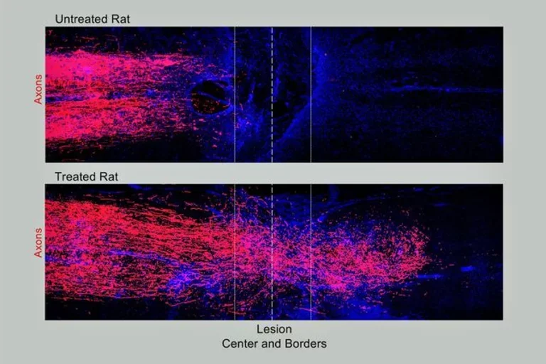 At top, spinal cord tissue in an untreated rat shows the damaged axons stopping at the border of the injury. Bottom image shows that the axons in a treated rat regrew across the spinal cord injury, creating new connections in tissue on the other side.
